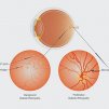 Диабетна ретинопатия ( Diabetic Retinopathy )