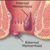 Хемороиди