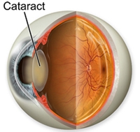 лекуване на катаракта с билки