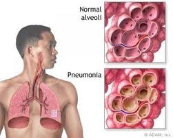 бронхит пневмония при възрастни