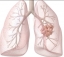Резултатите от проучването LUME-Lung 1 показаха, че Nintedanib плюс химиотерапия удължава живота на пациентите с рак на белия дроб с аденокарцином